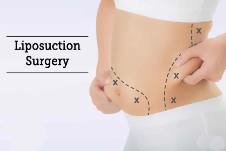 liposuction